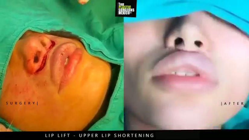 Lip Lift in Mexico - TopPlasticSurgeonsMexico 8